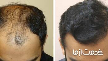 آشنایی کامل با ترمیم مو سر و مزایای ویژه آن