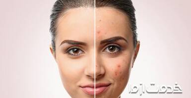 سریع‌ترین و آسان‌ترین درمان جوش صورت