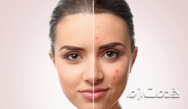 سریع‌ترین و آسان‌ترین درمان جوش صورت