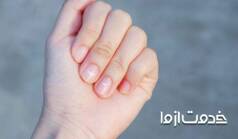 علت لکه سفید روی ناخن چیست؟