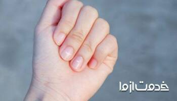 علت لکه سفید روی ناخن چیست؟