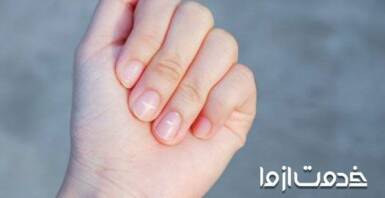 علت لکه سفید روی ناخن چیست؟