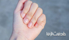 علت لکه سفید روی ناخن چیست؟