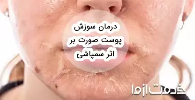 درمان سوزش پوست صورت بر اثر سمپاشی