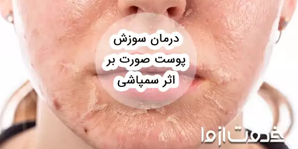 درمان سوزش پوست صورت بر اثر سمپاشی