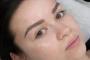 میکروبلیدینگ و میکروپیگمنتیشن