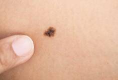 برداشتن خال