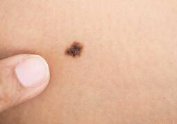 برداشتن خال