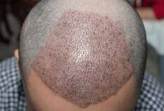 کاشت مو طبیعی