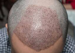 کاشت مو طبیعی