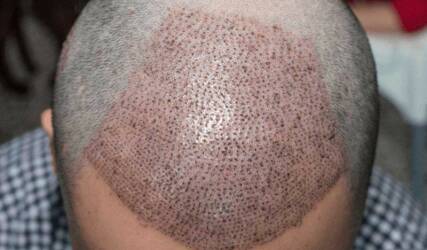 کاشت مو طبیعی