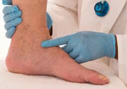 رفع ضایعات عروقی پوست