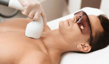 لیزر موهای زائد