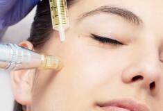 مزوتراپی صورت